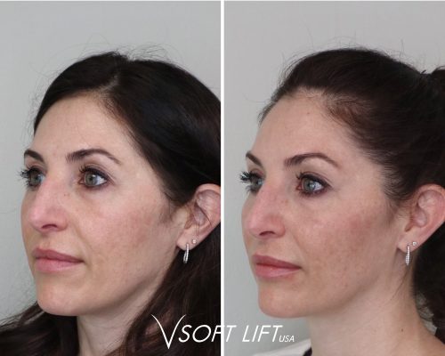 Full Face Treatment