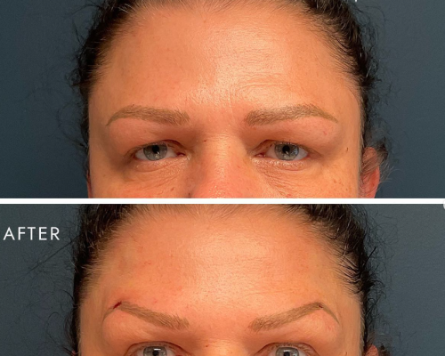 Brow Lift Brow Lift