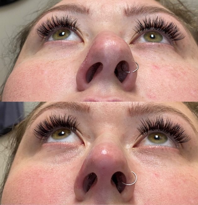 Nose Thread Lift Before and After Image Illustration