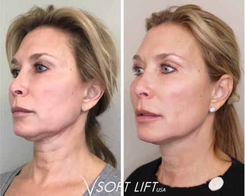 Vsoft_necklaceLines Necklace Lines Treatment